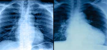 تشخیص بیماری قلبی با اشعه ایکس