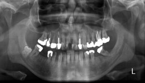 نمونه ای از رادیوگرافی پانورامیک برای ارتودنسی دندان