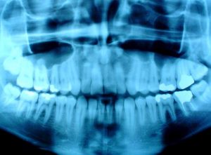 تشخیص آبسه دندان با رادیولوژی