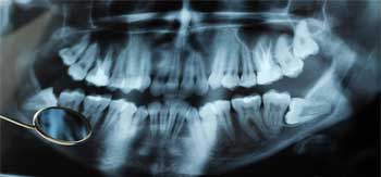 تشخیص آبسه دندان با رادیولوژی