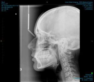 عکس رادیولوژی از شکستگی بینی