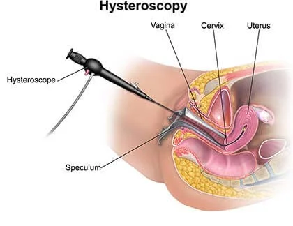 هیستروسونوگرافی چیست؟