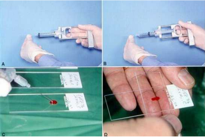 FNA تیروئید چیست و چگونه انجام میشود